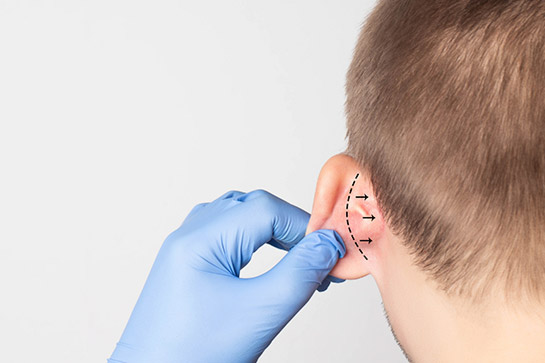 infografia de operación para corregir las orejas de soplillo