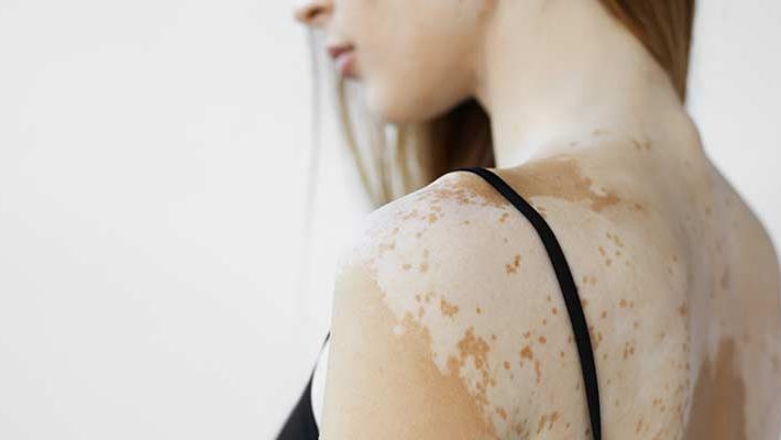 Vitíligo: causas de la despigmentación de la piel
